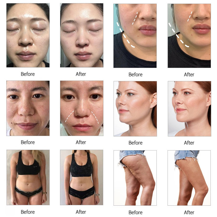 Lumicutis 10-in-1 Multi-Pole RF & Acoustic Body Contouring Platform
